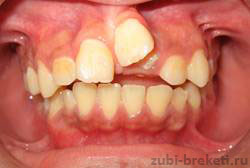 дистопия зубов