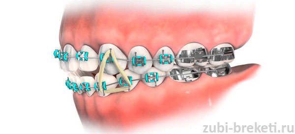 ортодонтическая конструкция