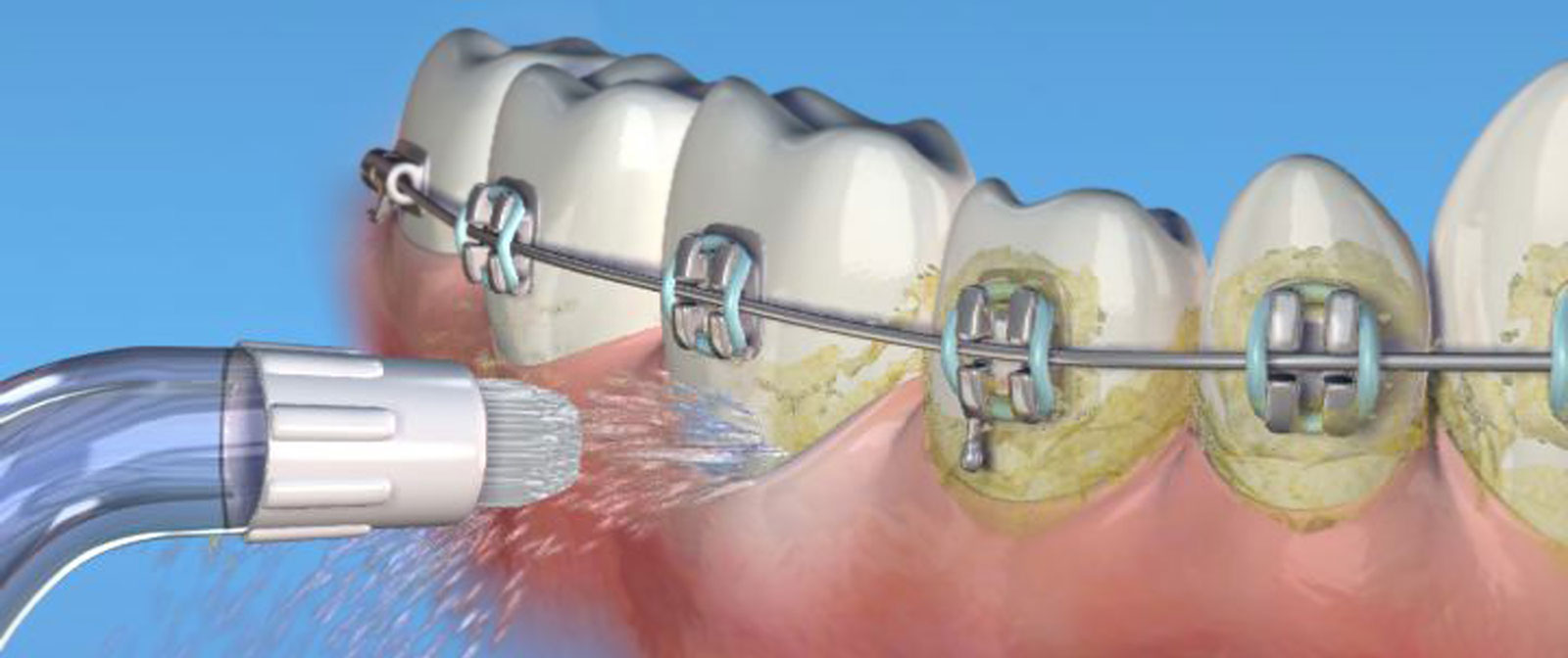 Десен системы. Ортодонтический суперфлосс. Ирригатор для полости рта брекеты. Приборы для чистки зубов с брекетами.