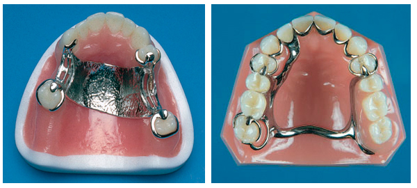 Ортодонтические конструкции на 1 челюсть