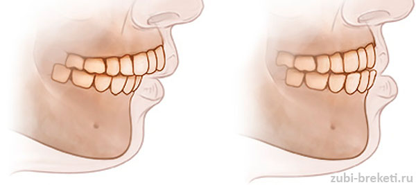самостоятельная диагностика неправильного прикуса