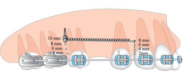 размер ортодонтических мини имплантов