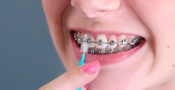 уход за ортодонтическими мини имплантатами