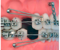 ортодонтические мини-импланты