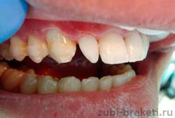 шиповидная аномалия зубов