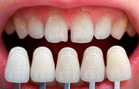 выравнивание зубов винирами и люминирами
