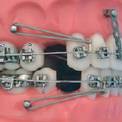 Ортодонтические мини-имплантаты